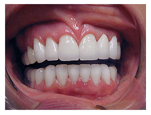 Porcelain Veneers result, after