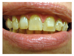 Porcelain Veneers result, before