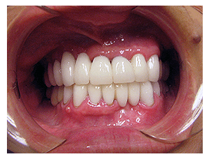 Porcelain Veneers result, after