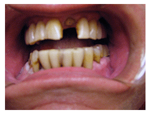 Porcelain Veneers result, before