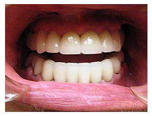 Porcelain Veneers result, after