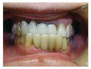 Porcelain Veneers result, before