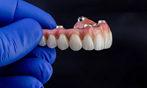 Gloved hand holding an implant-supported denture with titanium connectors