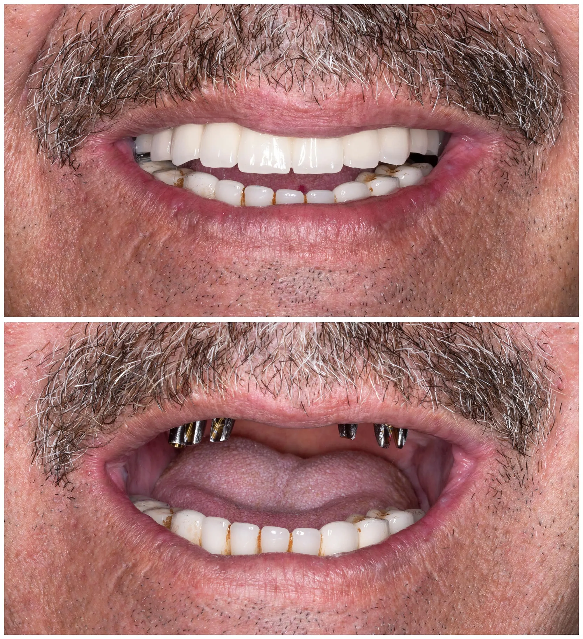 Before and after: upper implant posts in place, then the finished implant-supported teeth attached