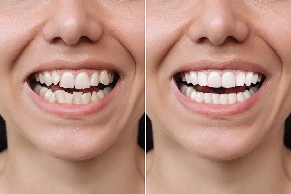Before and after: crooked, uneven front teeth beside the same smile straightened and evenly aligned
