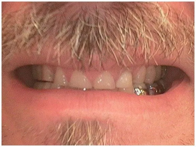 Smile Gallery result, before