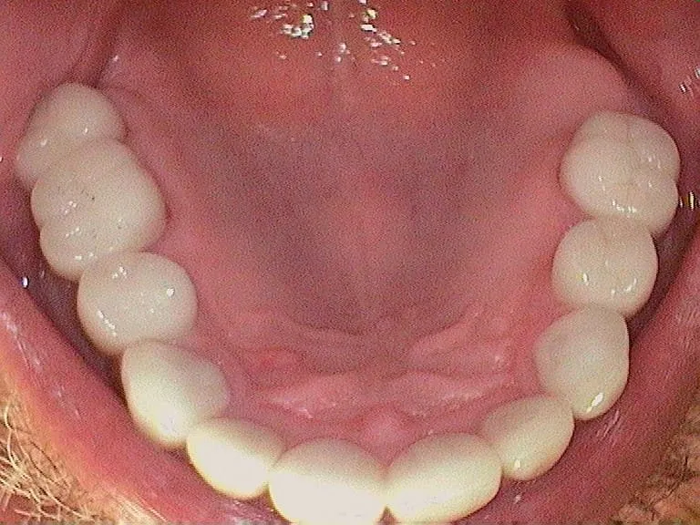 Smile Gallery result, after