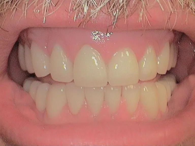 Smile Gallery result, after