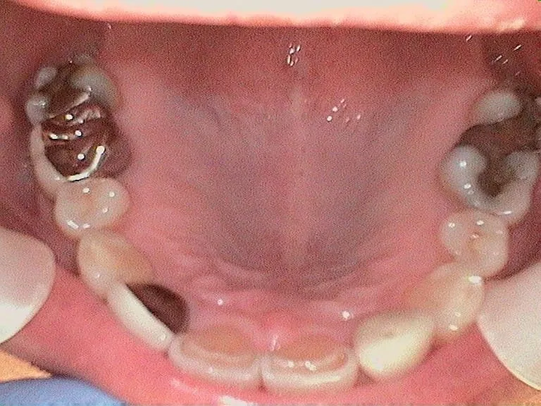 Smile Gallery result, before