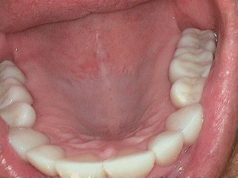Smile Gallery result, after