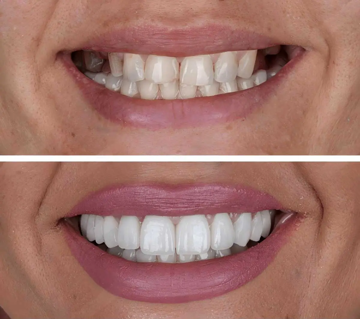 Smile before and after implant-supported dentures