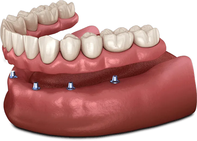 Model of a lower denture snapping onto mini implants