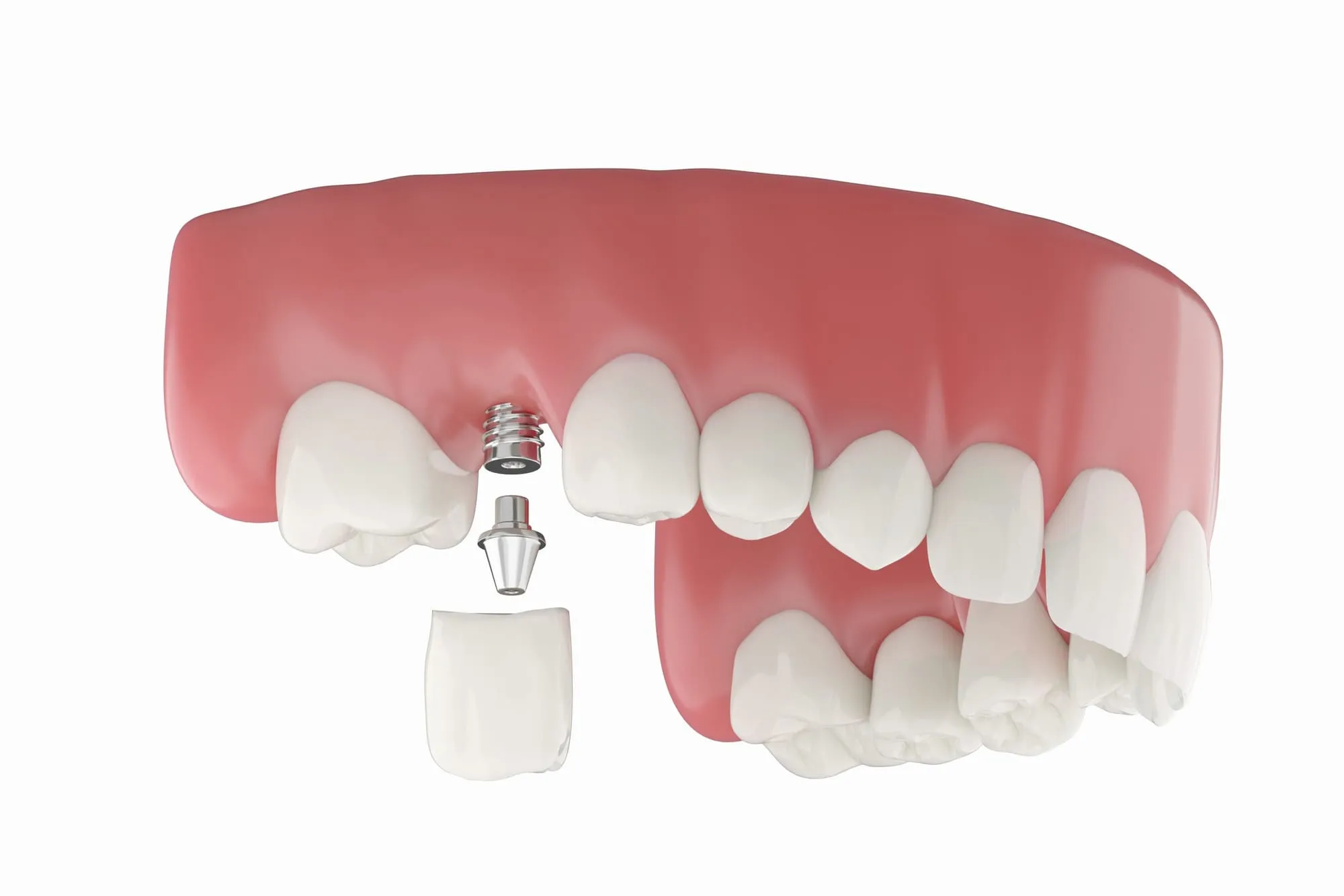 Single dental implant with crown beside natural teeth