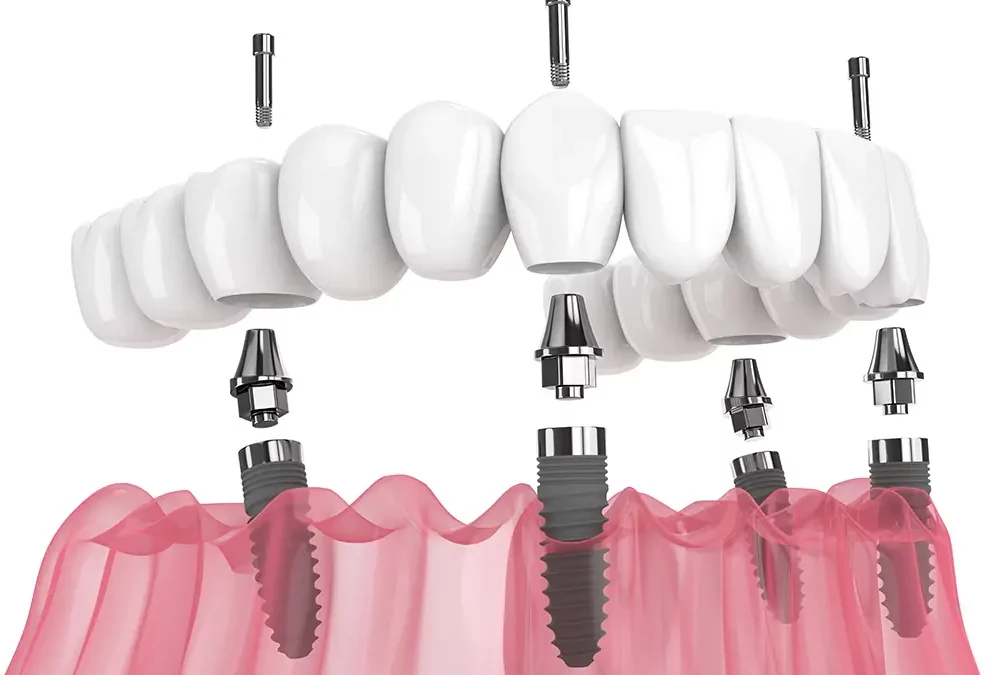 Dental implants and crown bridge illustration