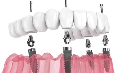 All-on-4 Dental Implants in Las Vegas